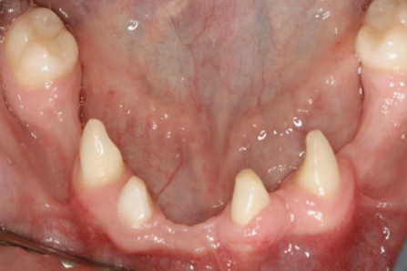 <p>inherited condition in which 2 or more ectodermally derived structure fail to develop (e.g skin, hair nail, teeth, sweat glands); AD, AR, X-linked; decreased # of teeth, Per > Dec</p>