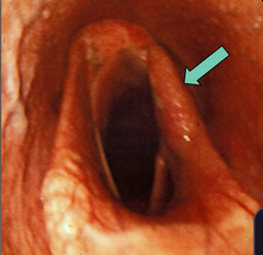 <p>Left sided laryngeal hemiplegia (although the more common side overall), typically affects what breed of horse?</p>