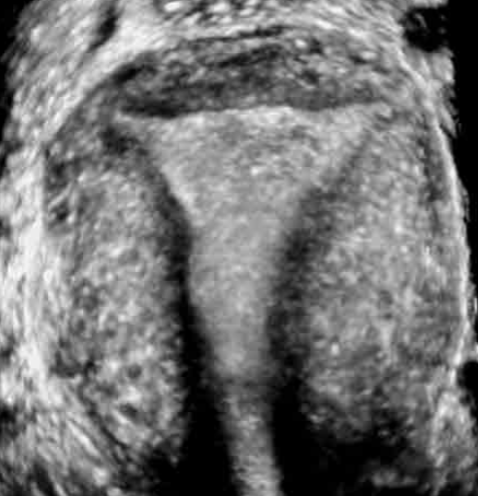 <ul><li><p>bicornuate uteus has small association w/ fetility complications</p></li><li><p>septate uterus has high association w/ intertility</p><ul><li><p>2 uterine cavities w/ single fundus</p></li><li><p>problems w/ implantation</p></li></ul></li></ul><p></p>