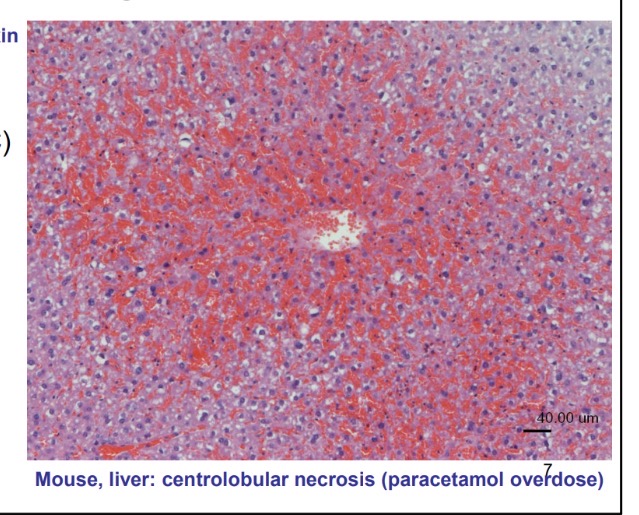 <p>acute toxic hepatosis - histo</p>