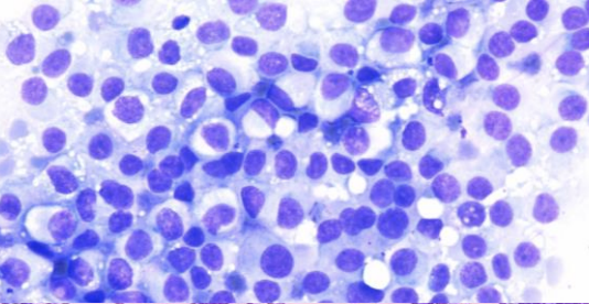 <p>Kyste du pancreas</p><p>1) diagnostic</p><p>2) morphologie</p><p>3) biochimie</p><p>4) altérations moléculaire</p><p>5) altérations moléculaire de haut risque</p><p>6) risque de malignité</p>