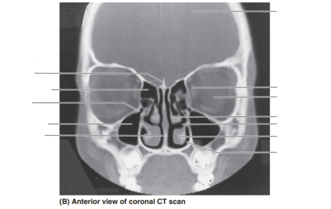<p>Please label this coronal CT scan </p>