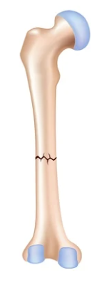 <p>Fracture line runs <strong>perpendicular (90°)</strong> to the long axis of the bone, usually caused by <strong>direct bending force</strong> or <strong>blunt trauma</strong>, considered a <strong>simple fracture</strong>.</p>