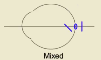 <p>Clinical Classification of Astigmatism based on focal points</p>