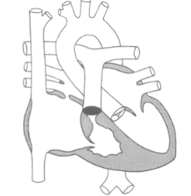 <ul><li><p>RV underdevelopment</p></li><li><p>due to compromised RV flow in fetal life</p><ul><li><p>caused by:</p><ul><li><p>TV atresia / stenosis</p></li><li><p>PV/PA atresia w/ IIVS</p></li></ul></li></ul></li><li><p>results in a small noncompliant RV that contracts minimally</p></li></ul><p></p>
