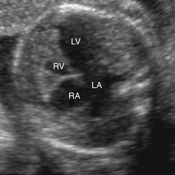 <p>4CH</p><p>enlarged LV</p><p>small/ absent RV</p>