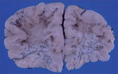 <p>What are the features of intraparenchymal hemorrhage due to ischemia (hemorrhagic conversion of ischemic infarct)?</p>