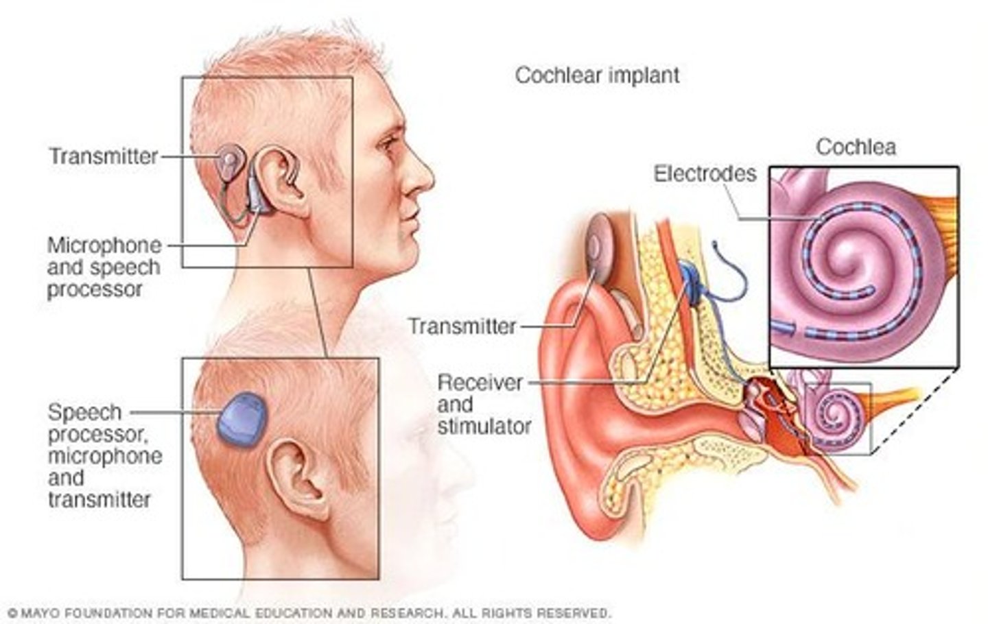 <p>Bypasses damaged portion of ear and directly stimulates auditory nerves</p>