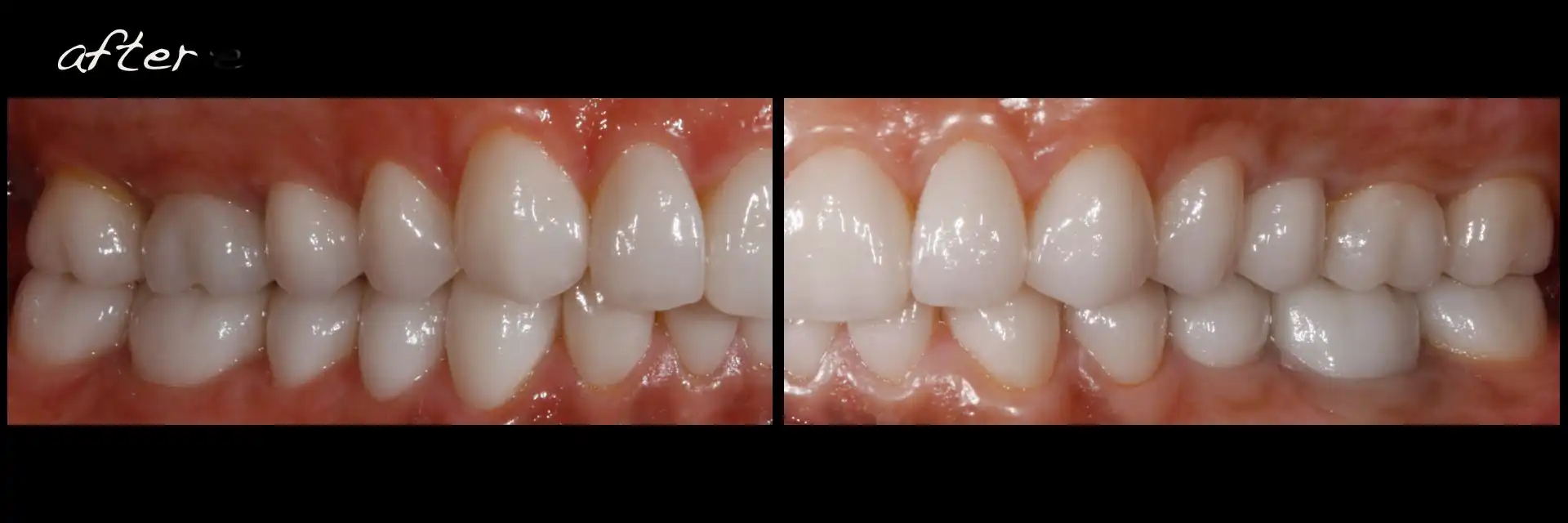 <p>What is the right molar occlusion? (pt’s right)</p>