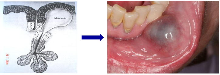 <p>mucous extravasation phenomenon (mucocele)</p>