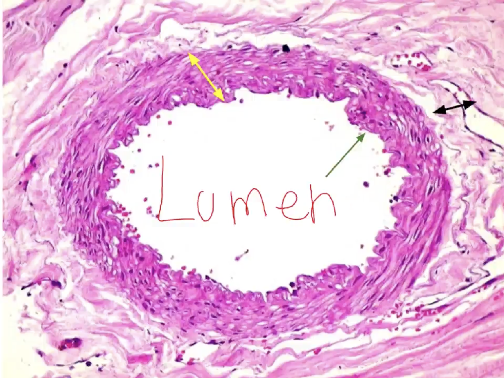 <p>- Artery (arteries have a narrower lumen and look tighter than veins, due to their thick tunica media)</p><p>- Green: Tunica intima/interna</p><p>- Yellow: Tunica media</p><p>- Black: Tunica externa</p><p>Middle is called the lumen</p>