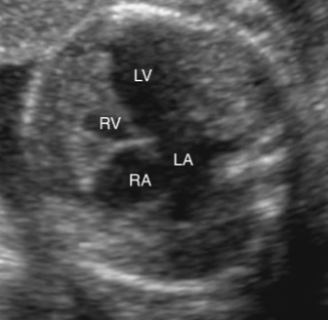 <ul><li><p><span style="color: red;">small RV</span></p></li><li><p>small or absent PA</p></li><li><p>PA stenosis</p></li><li><p>VSD may or may not be present</p></li></ul><p></p>