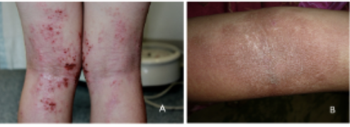 <p>Caso clínico de un infante de 2 años de edad, producto de parto distócico por cesárea, a las 40 semanas, debido a una desproporción cefalopélvica, alimentado con lactancia materna exclusiva hasta los 6 meses de vida, quien fue llevado a consulta por presentar prurito persistente, más exacerbado por la aparición de lesiones eritematopapulosas, en los pliegues de codos y rodillas, así como en el axilar izquierdo. Según los resultados los niveles de igE estaban elevados. Cuál puede ser su posible diagnóstico?</p>