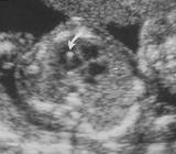 <p>One or more bright spots in the heart. Most frequently seen unilaterally in the left ventricle. Parts of the heart muscle with more calcium could result in a bright spot.</p>