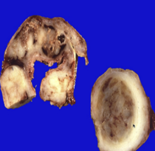 <p>⚠️39.Identify the causative organism of this fallopian tube lesion: A.Bacteroides B.Actinomyces israelii C.Mycobacterium tuberculosis D.Peptostreptococcus</p>