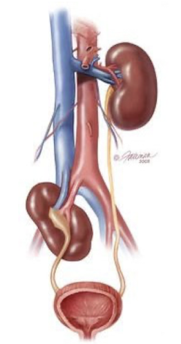 <ul><li><p>kidney not positioned within renal fossa</p><ul><li><p><span style="color: red;">usually lies in area of pelvis</span></p></li></ul></li><li><p>crossed ectopia: both kidneys may be fused or appear to be fused</p><ul><li><p>located on same side (usually right)</p></li><li><p>considered form of horseshoe kidney</p></li></ul></li><li><p>prognosis: depends on presence of additional anomalies; generally good</p></li><li><p>associated with:</p><ul><li><p>skeletal, GYN, GI, and cardiovascular anomalies </p></li></ul></li></ul><p></p>
