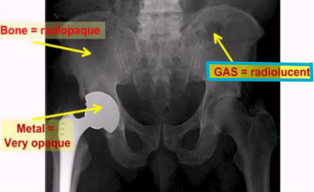 <ul><li><p><span style="background-color: transparent;">FB or structure that allows radiation to pass through easily</span></p></li><li><p><span style="background-color: transparent;">Appears black or dark gray</span></p></li><li><p><span style="background-color: transparent;">Ex: air, soft tissue, abscesses, dental pulp</span></p></li></ul><p></p>