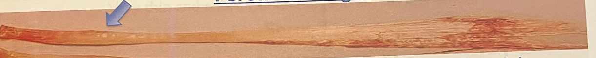 <p>-usually very long and narrow, tube end has a distinct dense bump in it</p><p>-most commonly confused with anterior</p>