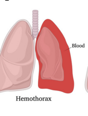<p>Blood in the pleural space </p><p>will be treated with chest tube</p>