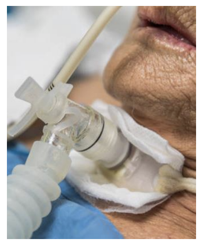 <p>Tube</p><p>Purpose: longer term airway/ventilation; allows for secretion management; improved comfort and oral hygiene for patient, may also allow for speech and nutrition</p>