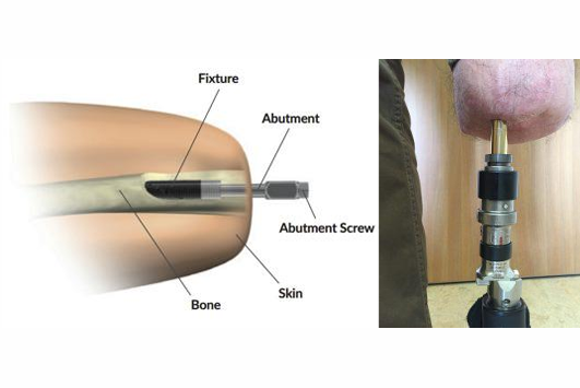 <ul><li><p>Osseointegration involves affixing an implant to the bone that allows direct fitment of limbs. </p></li><li><p>The implant permanently protrudes from the skin </p></li><li><p>This replaces the socket </p></li><li><p>If there is a fault with this implant then further amputations may be required </p></li><li><p>Implant technologies may become outdated </p></li><li><p>Risk of infections is increased during both surgery and post operation</p></li></ul><p></p>