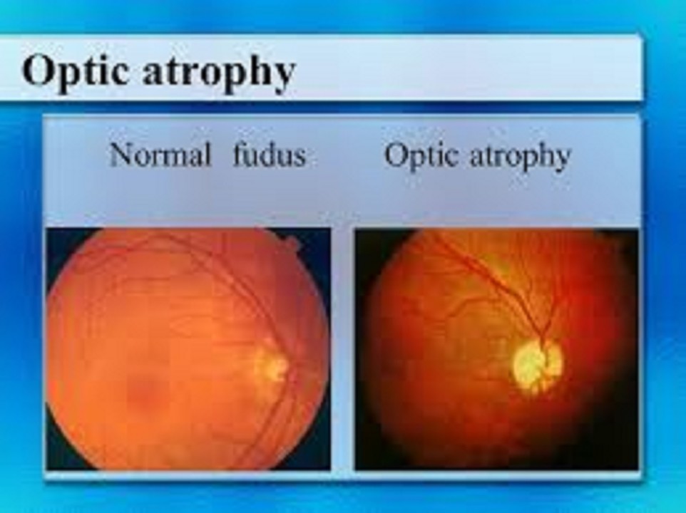 <p>pallor of the optic disc due to partial or complete death of optic nerve</p>
