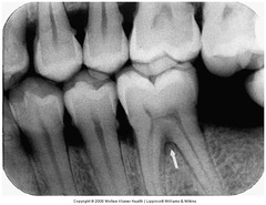 <p>dividing point of a multi-rooted tooth</p>