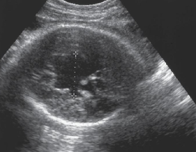 <p>cysts filled with cerebrospinal fluid that communicate with ventricular system or subarachnoid space </p>