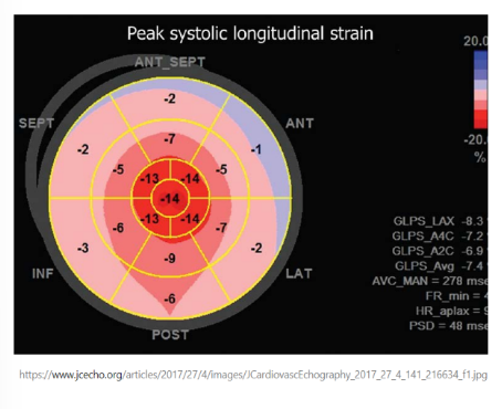<ul><li><p>Gradual deterioration of systolic function</p></li><li><p>Increased LV wall thickness</p></li><li><p>Normal to small LV cavity size</p></li><li><p>Ground-glass appearance of the myocardium*****</p></li><li><p>Apical sparing with a “cherry-on-top” strain pattern******</p></li><li><p>RV hypertrophy</p></li><li><p>Pulmonary hypertension</p></li><li><p>Valvular thickening and regurgitation</p></li><li><p>Progressive diastolic dysfunction and possible pericardial effusion</p></li></ul><p></p>
