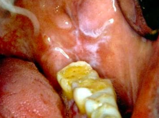 <p>white, keratotic lesion due to chronic irritation</p>