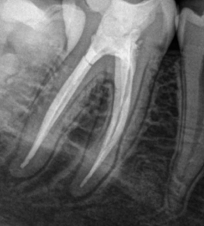 <p>What % of mandibular molars have 2 canals, and 1 foramina for their distal root?</p>