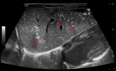 <p>What do you suspect, and what is an important etiology to keep in mind?</p>