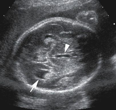 <p>12. What part of the lateral ventricle is the arrow indicating in Figure 24-36?</p><p>Figure 24-36</p><p>a. Temporal horn</p><p>b. Body</p><p>c. Anterior horn</p><p>d. Occipital horn</p>
