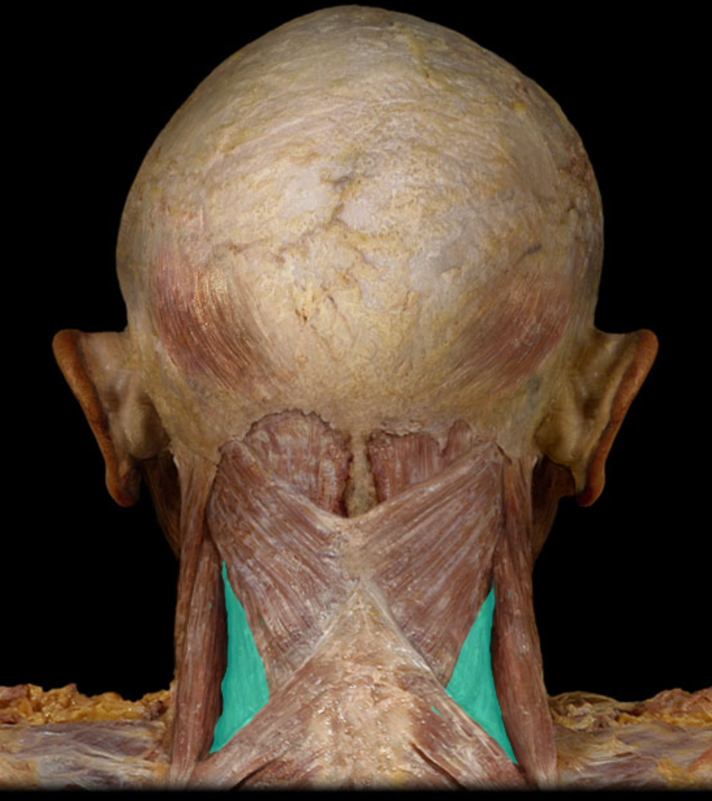 <p>Action:</p><ul><li><p>Unilateral: rotation of head to same side</p></li><li><p>Bilateral: extension of head and neck</p></li></ul><p>Origin:</p><ul><li><p>Spinous processes of T3-6 vertebrae</p></li></ul><p>Insertion:</p><ul><li><p>Transverse processes of C1-3 vertebrae</p></li></ul><p>Innervation:</p><ul><li><p>Dorsal rami of C3-5 spinal nerves</p></li></ul><p></p>