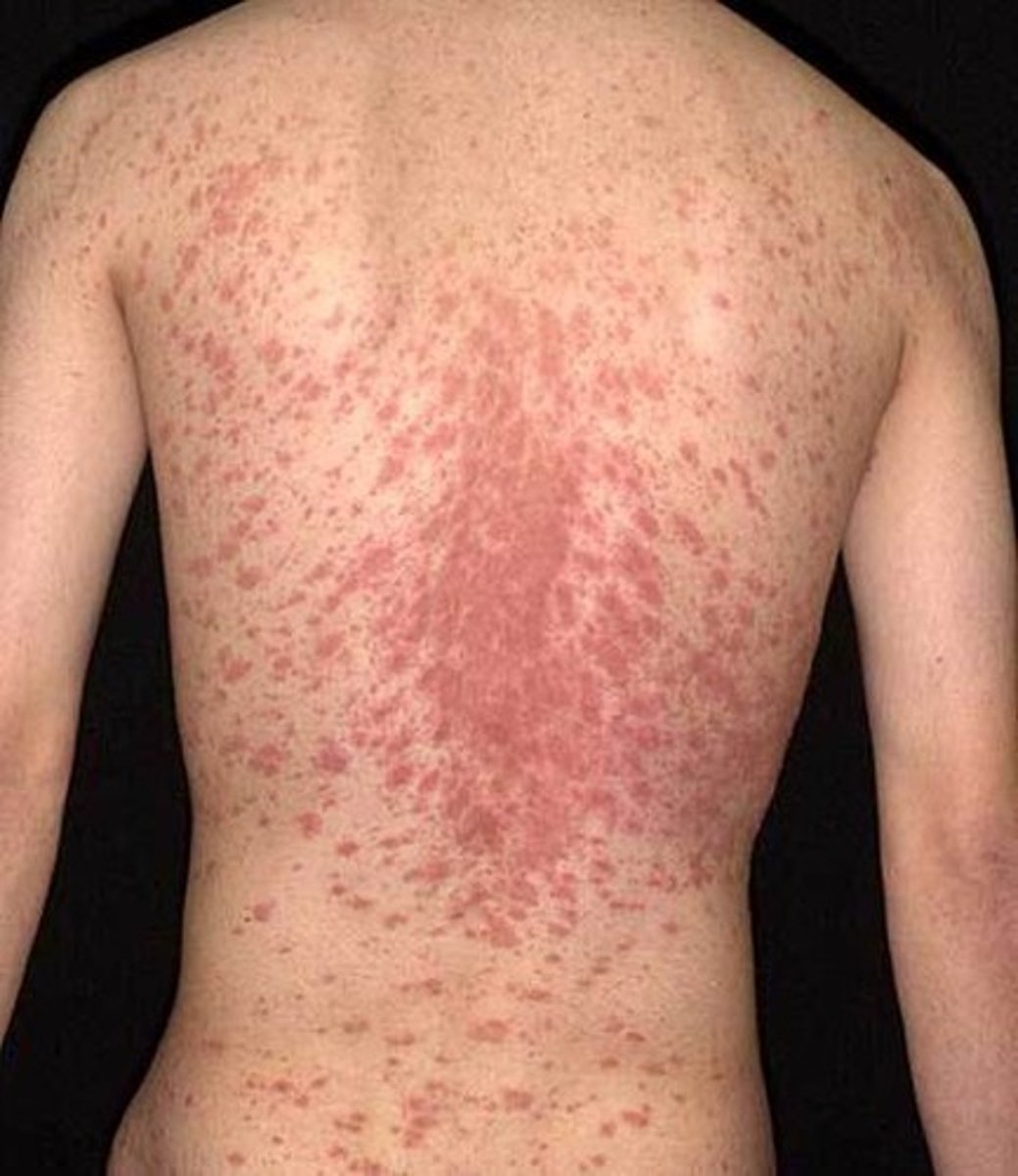 <p>-Christmas tree pattern</p><p>-oval lesions on the trunk in older children</p>