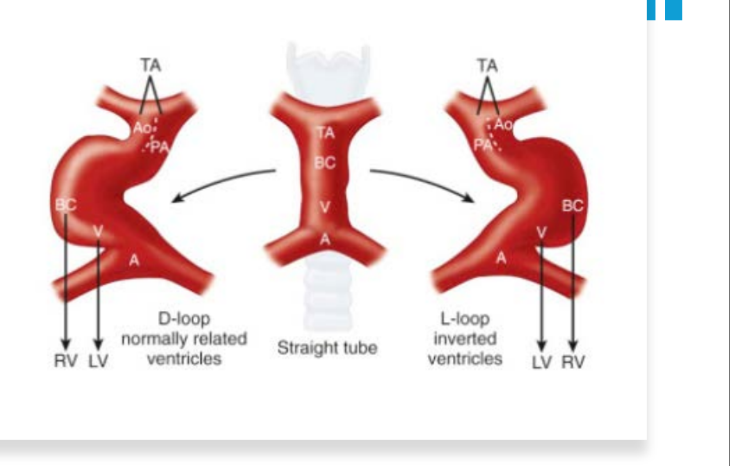 <p>Abnormal <strong>leftward looping</strong> of the heart tube causes:</p><ol><li><p>Atrioventricular discordance</p></li><li><p>Ventriculoarterial discordance</p></li></ol><p>(blubs lopping anterior - inferior and to the left - abnormal)</p>