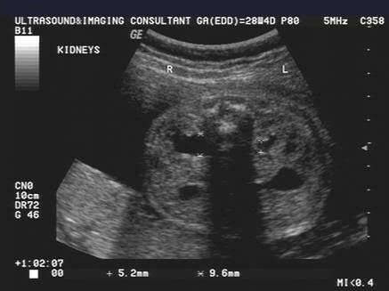 <ul><li><p>obstruciton of proximal ureter </p></li><li><p>m/c </p></li><li><p>hydronephrosis </p></li></ul><p></p>