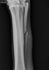 <p>How do you treat metatarsal 2 & 4 fractures (splint bones)? What the prognosis?</p>