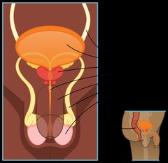 <p>Chemotherapy, usually combined with surgery.</p>