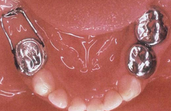 <p>what space maintainer:</p><p>- Molar band or stainless steel crown is soldered to a post</p><p>- Post is inserted into the alveolar bone mesial to the 1st molar</p><p>- Used when patient has lost the primary 2nd molar prior to the eruption of the permanent 1st molar</p><p>Pros</p><p>- Can be used if permanent 1st molars are unerupted</p><p>- Bone borne</p><p>- Fixed</p><p>- Increased comfort</p><p>- Ease of oral hygiene</p><p>Cons</p><p>- Boney pin can be inserted into path of erupting teeth or into the crown of the erupting teeth</p><p>- Unilateral</p><p>- Can impede eruption of permanent teeth depending on path of eruption and size of wire window</p><p>- Requires multiple radiographs</p><p>- Custom appliance</p>