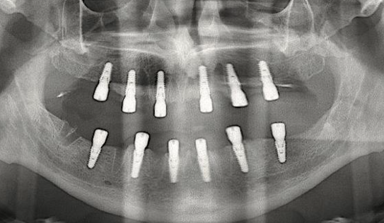 <p><span>Is surgically placed into the bone</span></p><p><span>• Shaped like a small screw, cylinder or blade</span></p><p><span>• The </span><span style="color: rgb(255, 0, 0);">most popular </span><span>implant</span></p>