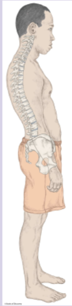 <p>this image best implicates which postural abnormality?</p><ul><li><p>dowagers hump</p></li><li><p>Sway back</p></li><li><p>Kordosis</p></li></ul><p></p>