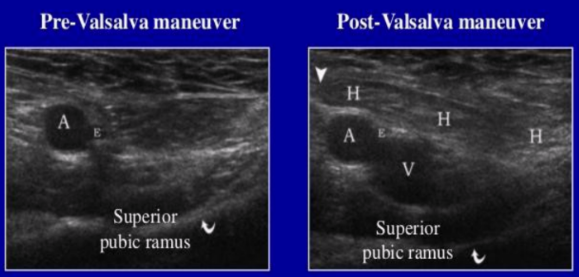 <ul><li><p><u>Most common form of hernia</u></p></li><li><p>Occurs lateral to IEV</p></li><li><p>Congenital hernia</p></li><li><p>20x more common in men than women</p></li><li><p>Can extend into the scrotum in men and labia majora in women</p></li><li><p><span style="background-color: transparent;">More likely to become strangled than direct inguinal</span></p></li><li><p><span style="background-color: transparent;">⅓ are bilateral, but are more common on the right side if unilateral</span></p></li></ul><p></p>