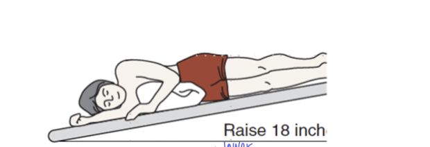 <p>a clinician is educating the patient’s parents on postural drainage. the clinician places the patient in a position, as shown in the image below. Which of the following segments of the lungs is MOST LIKELY being drained?</p><p>a. right lateral basal segment </p><p>b. right middle lobe</p><p>c. left lingular segment </p><p>d. left lateral basal segment </p>