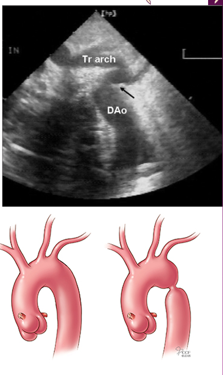 <p>VSD, PDA, bicsupid ao valve </p>