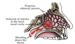 <p>consider consult to ENT or OMFS for placement of balloon catheter</p>