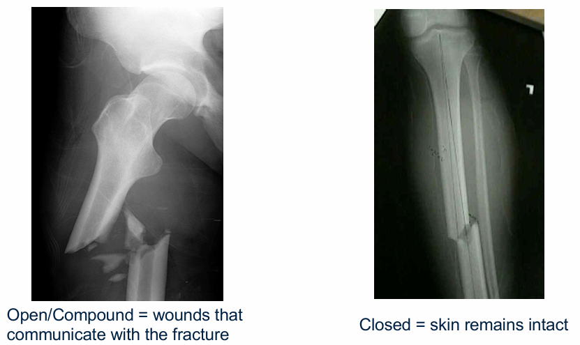 <p>Open fractures communicate with the external environment (e.g. femur poking through the skin)</p>