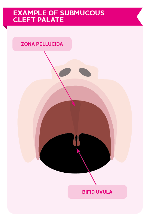 <p>submucous cleft</p>