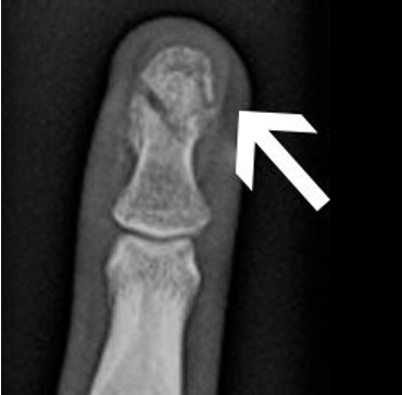 <p>What type of fracture is shown in the image?</p>