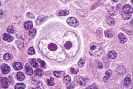 <p>reed-sternberg cells (owl eyes)</p>